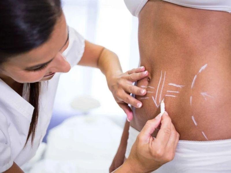 Understanding Liposuction: A Fat Removal Surgery