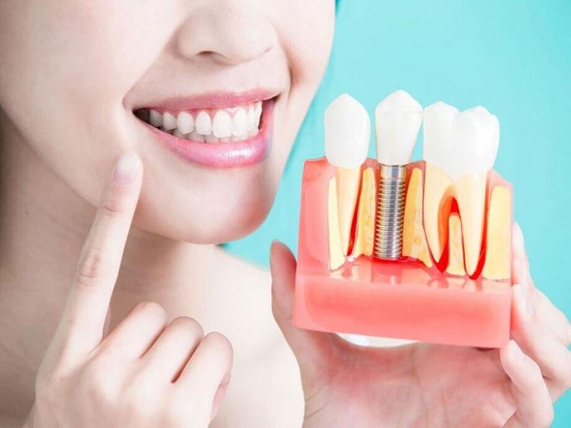 Know How You Can Get Dental Implants At A Low Cost