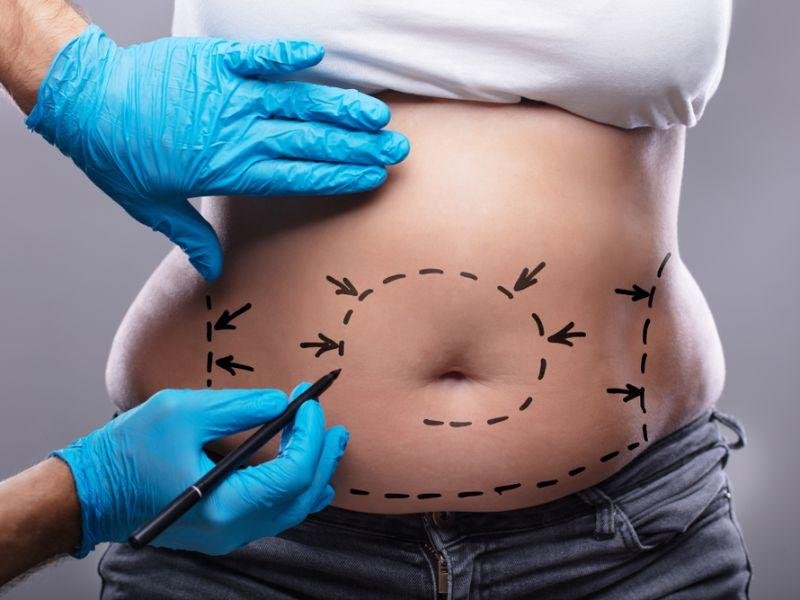 The Basics of Abdominoplasty (Tummy Tuck) Surgery
